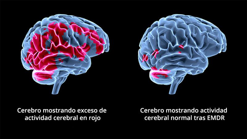 eficacia-terapia-emdr